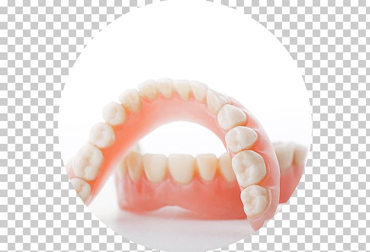 Dentistry Dentures Southwood Dental Studio Tooth PNG, Clipart, Bridge, Bunch, Clinic, Cosmetic Dentistry, Dental Implant Free PNG Download