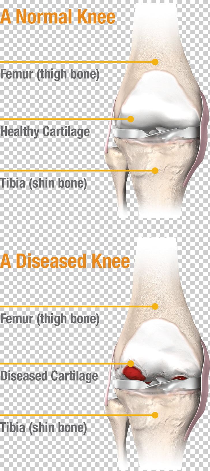 Knee Pain Joint Meniscus Knee Replacement PNG, Clipart, Ache, Aea, Anatomy, Arm, C 63 Free PNG Download
