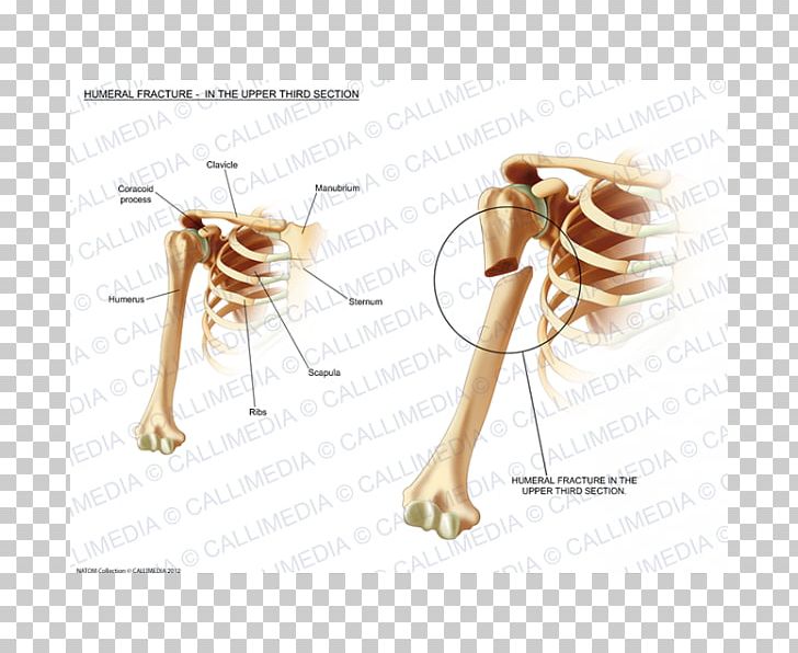 Humerus Fracture Bone Fracture Injury Sternum PNG, Clipart, Anatomy, Arm, Bone, Bone Fracture, Ear Free PNG Download