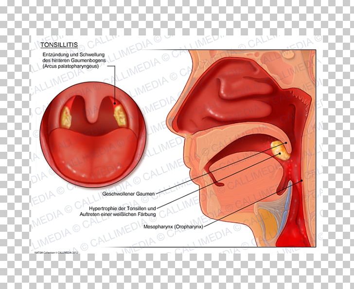 Tonsillitis Otorhinolaryngology Pharyngitis Oropharyngeal Cancer PNG, Clipart, Anatomy, Disease, Ear, Jaw, Lip Free PNG Download