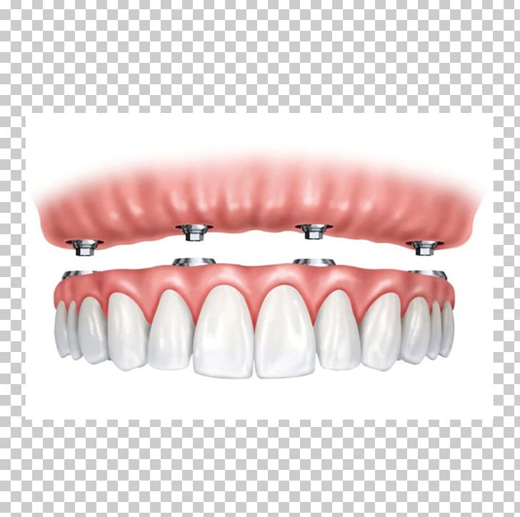 All-on-4 Dental Implant Dentures Dentistry PNG, Clipart, All On 4, Allon4, Dental Implant, Dentistry, Dentures Free PNG Download