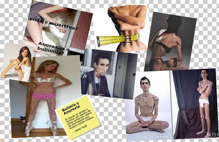 Anorexia Nervosa Bulimia Nervosa Disease Symptom PNG, Clipart, Advertising, Anorexia, Anorexia Nervosa, Brand, Bulimia Nervosa Free PNG Download