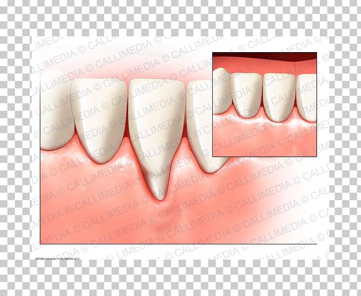 Tooth Gums Surgery Periodontal Disease Gingival Recession PNG, Clipart, Dental Implant, Dentist, Dentistry, Gingival Graft, Gingival Recession Free PNG Download