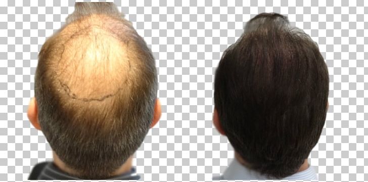 Hair Transplantation Follicular Unit Extraction Step Cutting Long Hair PNG, Clipart, Brown Hair, Cutting, Follicular Unit Extraction, Hair, Hair Coloring Free PNG Download