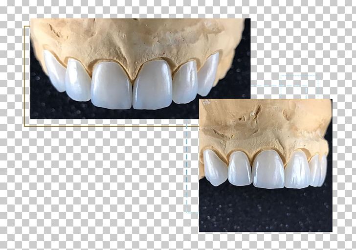 Veneer Porcelain Aesthetics Human Tooth PNG, Clipart, Aesthetics, Human Tooth, Jaw, Mouth, Organ Free PNG Download