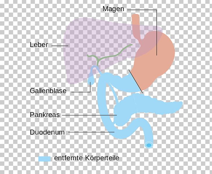 Pancreaticoduodenectomy Pancreatic Cancer Pancreas Thumb Surgery PNG, Clipart, Angle, Area, Arm, Cancer, Communication Free PNG Download