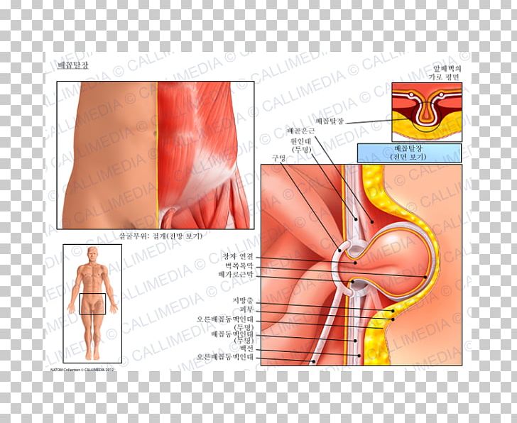 Umbilical Hernia Inguinal Hernia Hernia Repair Abdominal Hernia PNG, Clipart, Abdomen, Angle, Arm, Baltoji Linija, Blood Vessel Free PNG Download