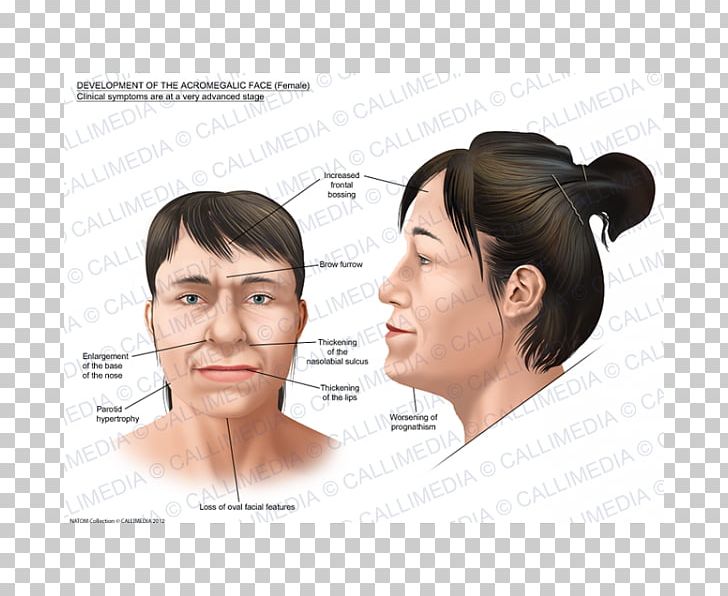 Acromegaly Face Gigantism Symptom Nose PNG, Clipart, Acromegaly, Cause, Cheek, Chin, Ear Free PNG Download