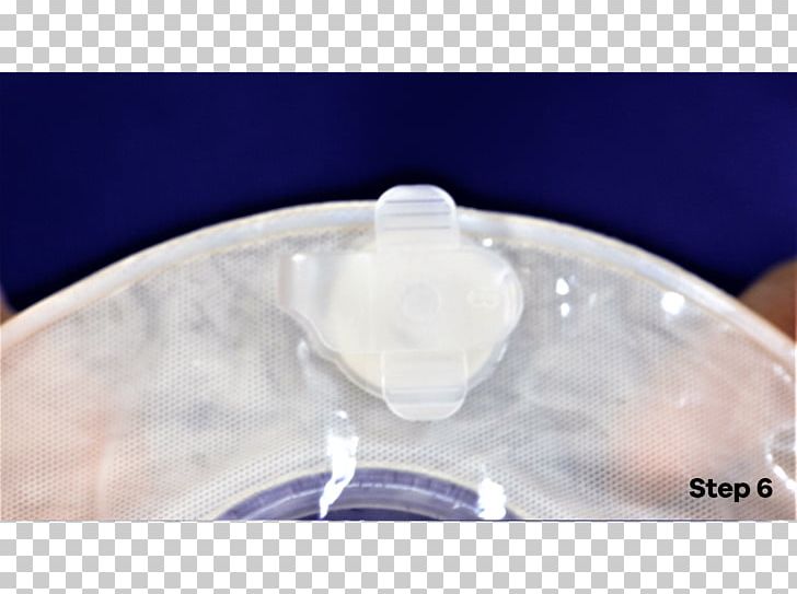 Stoma Colostomy Ostomy Pouching System Laryngectomy United Kingdom PNG, Clipart, Bag, Bangkok Nurse Care Co Ltd, Colostomy, Daily Star, Glass Free PNG Download