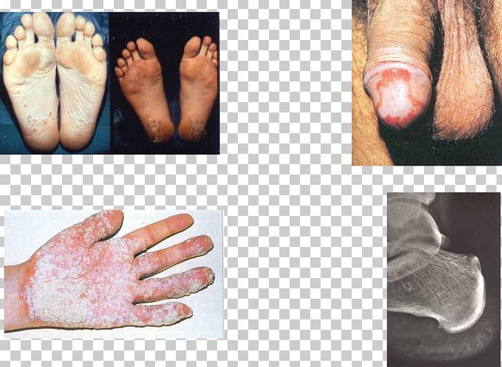 Reactive Arthritis Disease Balanitis Circinata Spondyloarthropathy PNG, Clipart, Arm, Arthritis, Balanitis Circinata, Chlamydia Infection, Conjunctivitis Free PNG Download