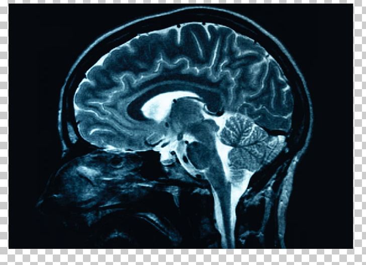 Human Brain X-ray Head Injury Medicine PNG, Clipart, Bone, Brain, Computed Tomography, Dental Radiography, Frontal Lobe Free PNG Download