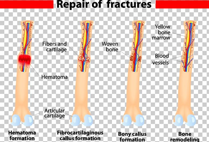 Bone Healing Bone Fracture Wound PNG, Clipart, Arm, Blood Vessel, Bone, Bone Fracture, Bone Healing Free PNG Download