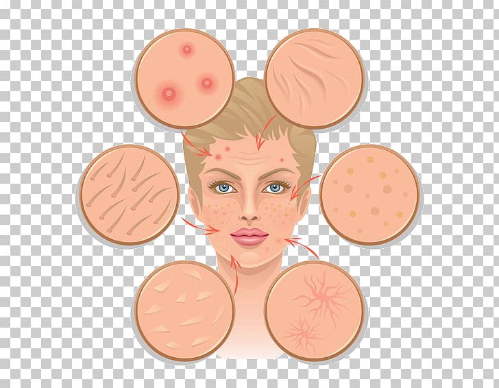 Skin Infection Human Skin PNG, Clipart, Acne Scars, Beauty, Cheek, Cosmetics, Face Free PNG Download