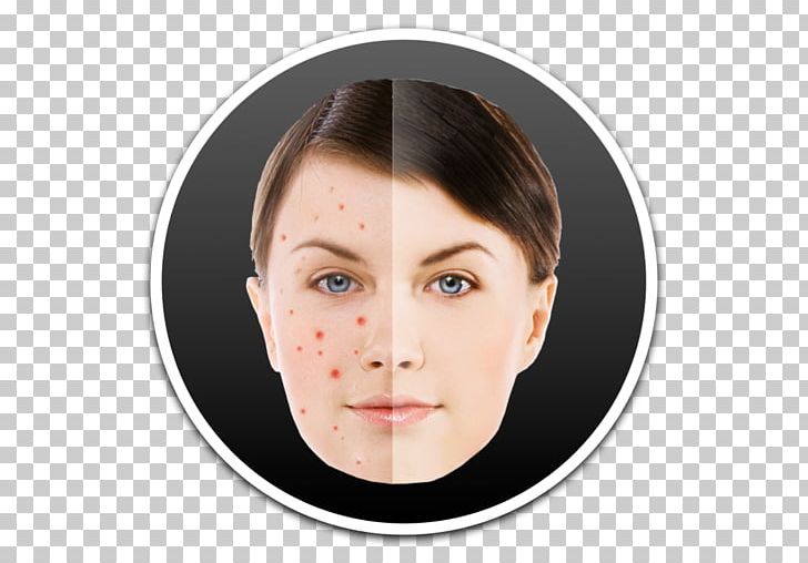 Pimple Acne Intense Pulsed Light PNG, Clipart, Acne, Apple, Cheek, Chin, Comedo Free PNG Download