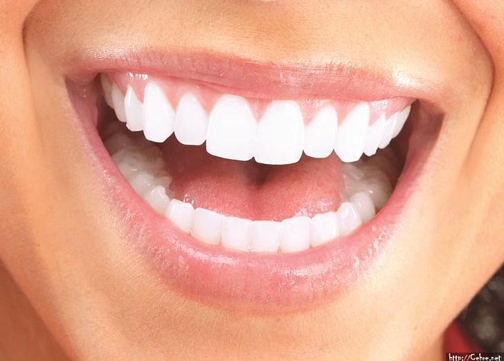 Cosmetic Dentistry Veneer Dental Restoration Makeover PNG, Clipart, Chin, Closeup, Cosmetic Dentistry, Dental Bonding, Dental Implant Free PNG Download