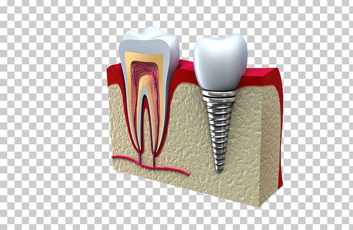 Dental Implant Dentistry Molar PNG, Clipart, Box, Bridge, Cosmetic Dentistry, Crown, Dental Implant Free PNG Download