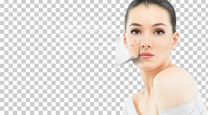 Skin Care Acne Health Therapy PNG, Clipart, Acne, Beauty, Cheek, Chin, Comedo Free PNG Download