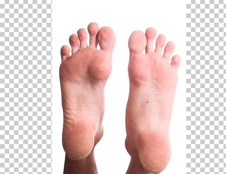 Callus Corn Podiatrist Foot Heel PNG, Clipart, Callus, Corn, Diseases Of The Foot, Erythema Nodosum, Finger Free PNG Download