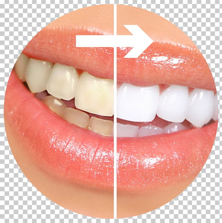 Tooth Whitening Cosmetic Dentistry Human Tooth PNG, Clipart, Clear Aligners, Cosmetic Dentistry, Crown, Dental Implant, Dental Impression Free PNG Download