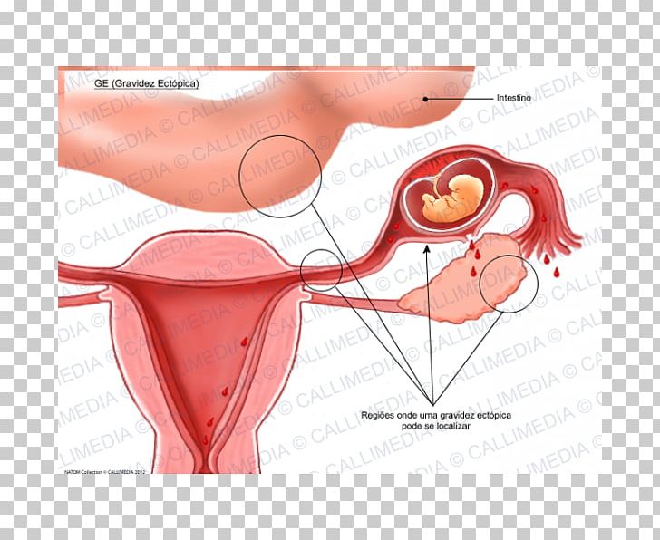 Ectopic Pregnancy Uterus Gynaecology Symptom PNG, Clipart, Abdomen, Abortion, Cheek, Chin, Ear Free PNG Download