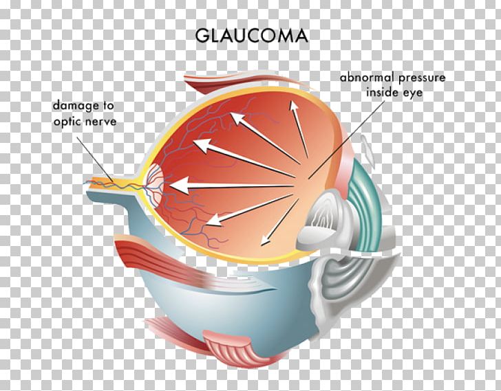 Intraocular Pressure Glaucoma Ocular Hypertension Eye Optic Nerve PNG, Clipart, Cup, Disease, Eye, Eye Care Professional, Eye Examination Free PNG Download