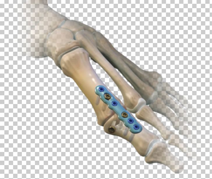 Metatarsophalangeal Joints Arthrodesis Hallux Rigidus Surgery Bunion PNG, Clipart, Arm, Arthritis, Arthrodesis, Bone, Bunion Free PNG Download