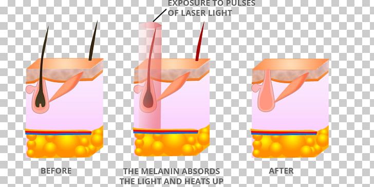 Laser Hair Removal Fotoepilazione Intense Pulsed Light PNG, Clipart, Artificial Hair Integrations, Beauty Parlour, Bikini Waxing, Drink, Fotoepilazione Free PNG Download