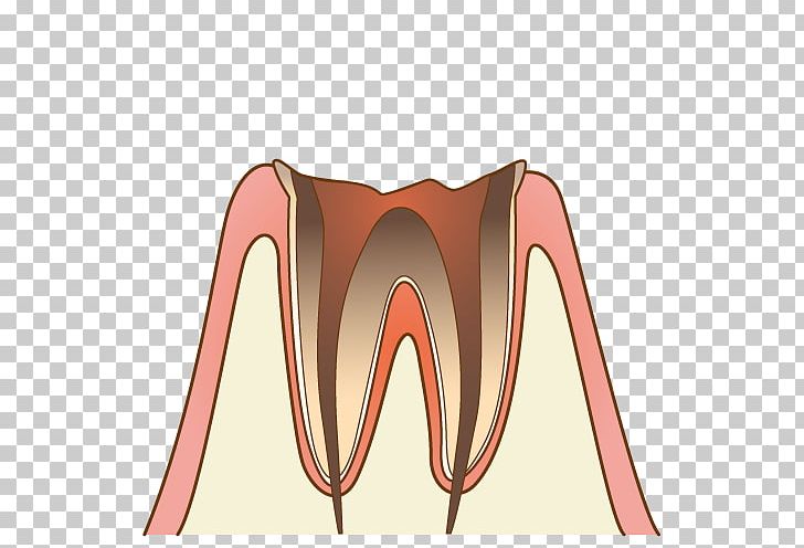 歯科 Dentist Periodontal Disease Tooth Decay PNG, Clipart, Angle, Dental Braces, Dentist, Disease, Inlays And Onlays Free PNG Download