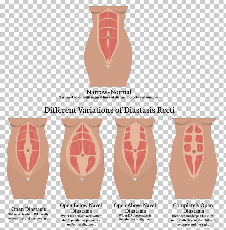 Diastasis Recti Rectus Abdominis Muscle Abdomen Physical Therapy PNG, Clipart, Abdomen, Active Undergarment, Back Pain, Diastasis Recti, Doctor Of Physical Therapy Free PNG Download