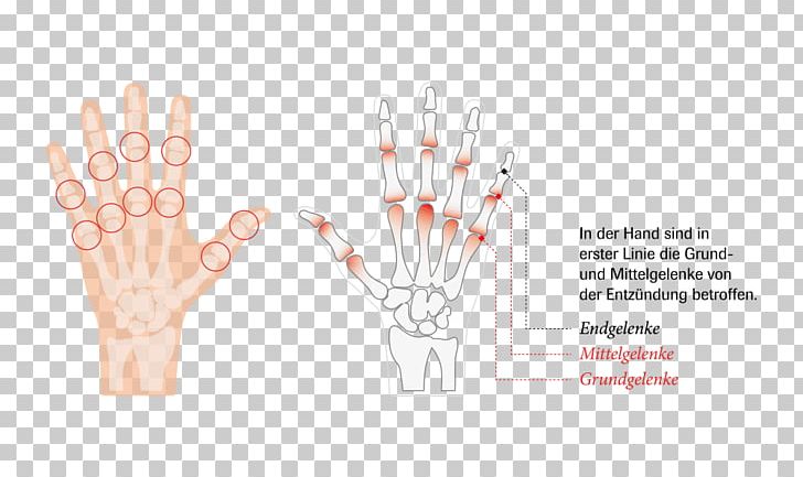 Joint Hand Rheumatoid Arthritis Rheumatism PNG, Clipart, Arm, Arthritis, Arthropathy, Disease, Finger Free PNG Download