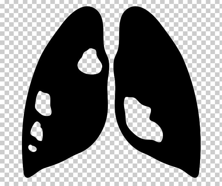 Lung Cancer Lung Cancer Computer Icons Respiratory Disease PNG, Clipart, Air Pollution, Black, Black And White, Cancer, Computer Icons Free PNG Download