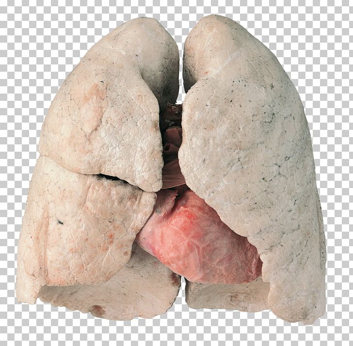 Lung Smoking Cessation Chronic Obstructive Pulmonary Disease PNG, Clipart, Bronchitis, Cancer, Cardiovascular Disease, Cigarette, Cough Free PNG Download