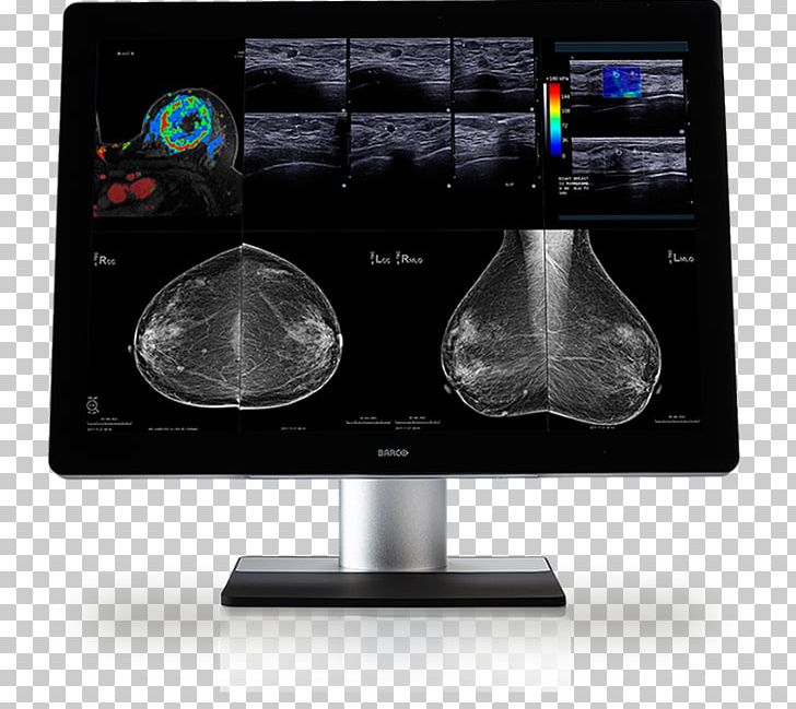 Computer Monitors Barco Digital Mammography Medical Imaging PNG, Clipart, Barco, Breast Cancer, Breast Imaging, Computer Monitors, Digital Mammography Free PNG Download