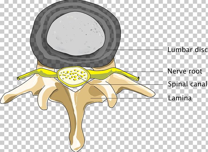 Spinal Disc Herniation Back Pain Spinal Stenosis Medical Diagnosis Vertebral Column PNG, Clipart,  Free PNG Download
