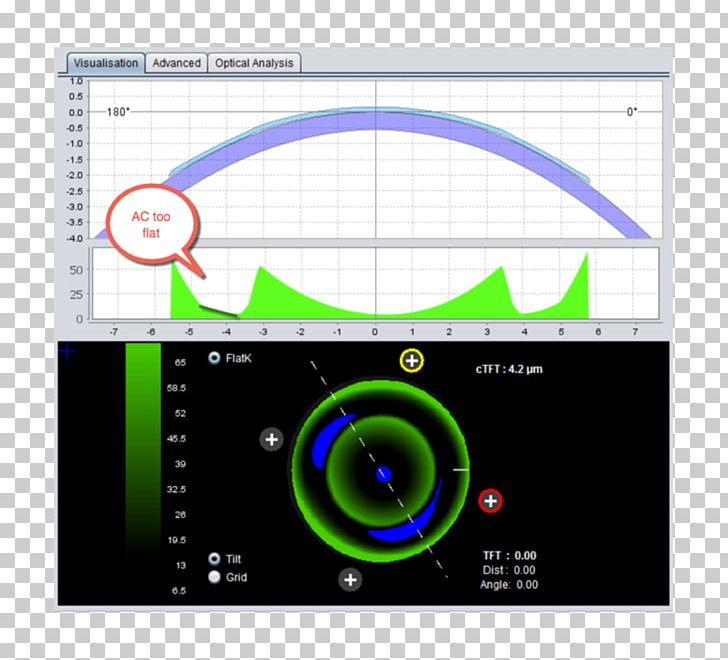 Orthokeratology Near-sightedness Cornea Optometry Astigmatism PNG, Clipart, Astigmatism, Brand, Circle, Computer Program, Cornea Free PNG Download