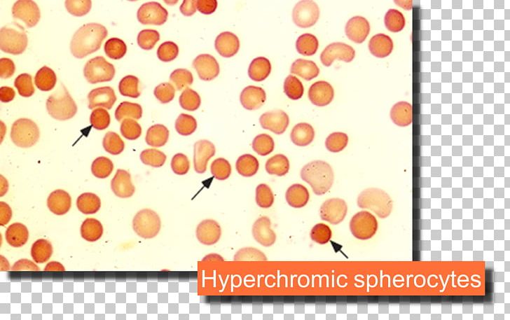 Microangiopathic Hemolytic Anemia Hemolysis Blood PNG, Clipart, Anemia, Blood, Cell, Cell Membrane, Circle Free PNG Download