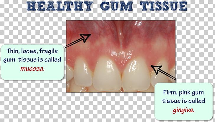 Tooth Periodontal Disease Gums Edentulism Dental Plaque PNG, Clipart, Chin, Dental, Dental Implant, Dental Plaque, Dentistry Free PNG Download