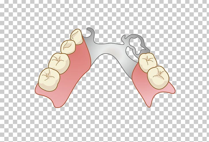 Dentures Dentist Removable Partial Denture Dental Technician Tooth Decay PNG, Clipart, Dental Implant, Dental Technician, Dentist, Dentistry, Dentures Free PNG Download