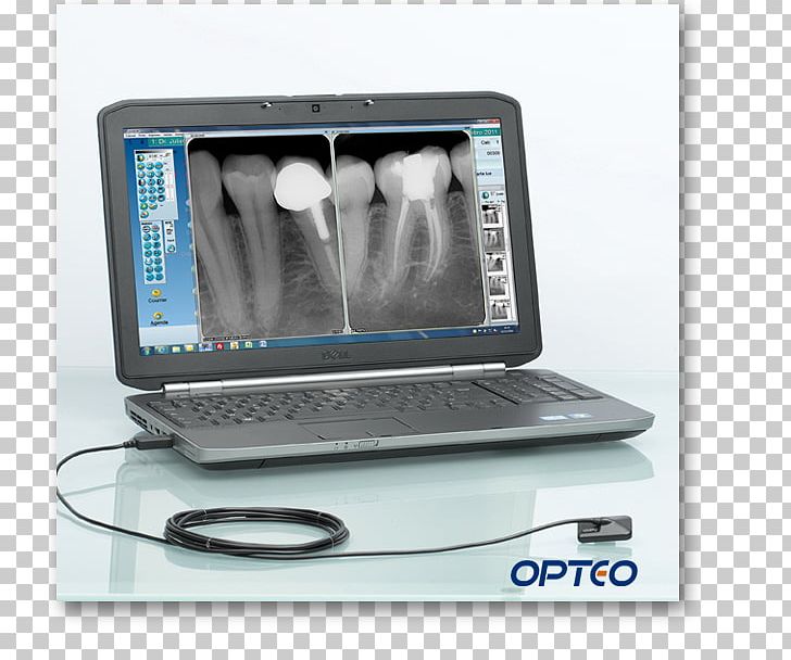 Dentistry Radiology Sensor Digital Radiography Dental Radiography PNG, Clipart, Dental Radiography, Dentistry, Digital Radiography, Endodontic Therapy, Equipo Dental Free PNG Download