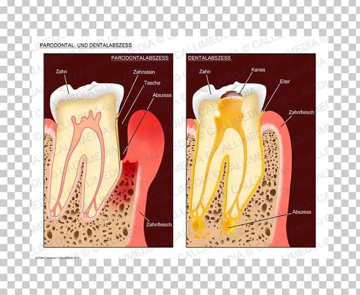 Dental Abscess Periodontal Disease Periodontal Abscess Gingivitis PNG, Clipart, Abscess, Amoxicillin, Amoxicillinclavulanic Acid, Antibiotics, Curettage Free PNG Download