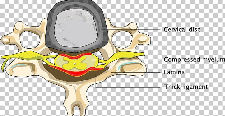Cervical Spinal Stenosis Neck Spinal Cord PNG, Clipart, Ache, Cartoon, Cervical, Cervical Spinal Stenosis, Cervical Vertebrae Free PNG Download