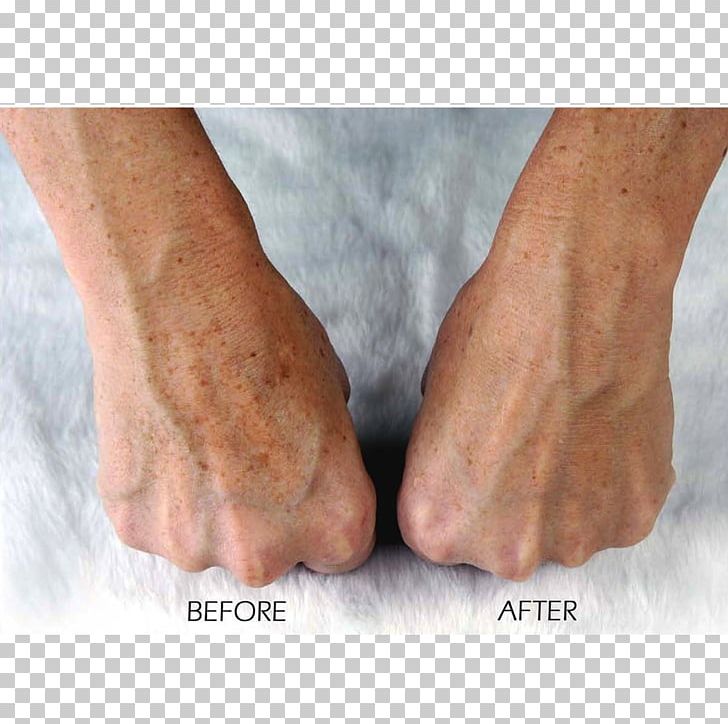 Trophy Skin MicrodermMD Home Microdermabrasion Machine Finger Exfoliation PNG, Clipart, Ankle, Arm, Calf, Comedo, Exfoliation Free PNG Download