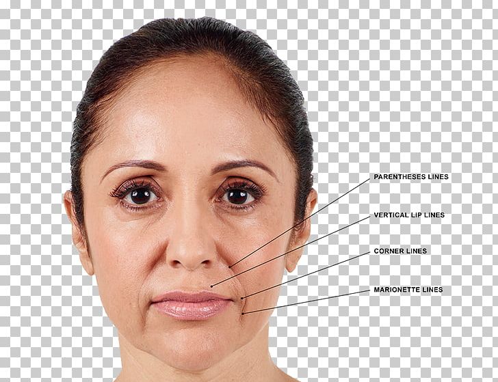 Injectable Filler Juvéderm Restylane Hyaluronic Acid PNG, Clipart, Artefill, Cheek, Chin, Closeup, Ear Free PNG Download