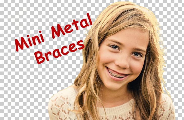 Dental Braces Orthodontics Clear Aligners Human Tooth PNG, Clipart, Braces, Brown Hair, Chewing, Child, Clear Aligners Free PNG Download