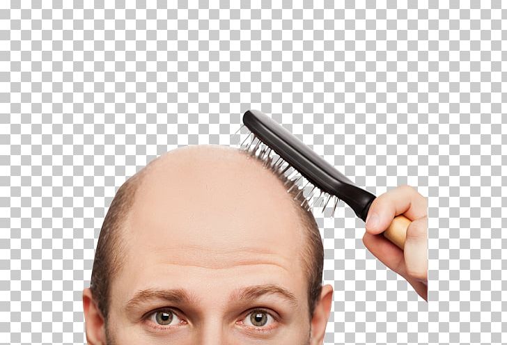 Hair Loss Health Hair Care Scalp PNG, Clipart, Capelli, Cheek, Chin, Dandruff, Eyebrow Free PNG Download
