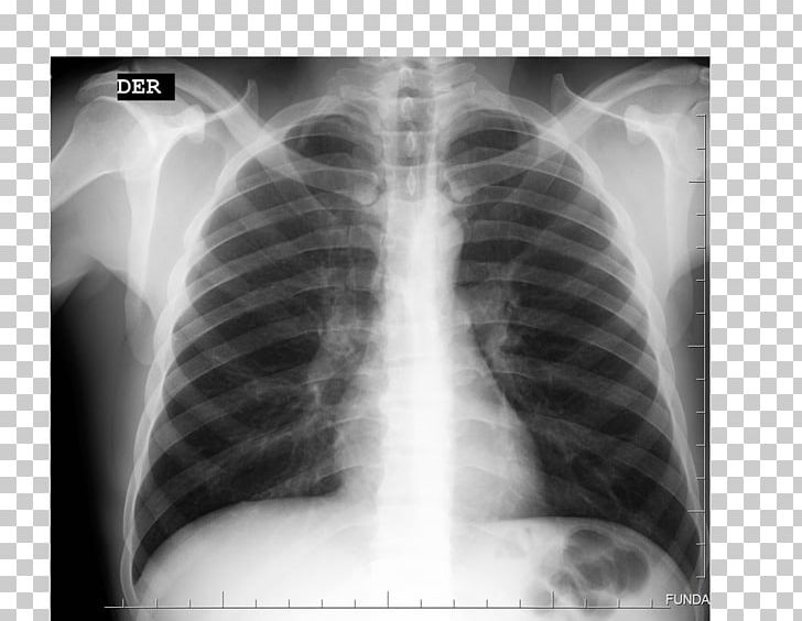 X-ray Radiology Radiography Rib Medical Imaging PNG, Clipart, Black And White, Breathing, Chest, Closeup, Disease Free PNG Download