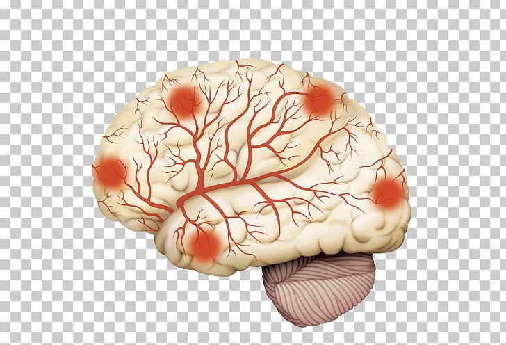 Disease Arteriosclerosis Cerebrum Intracranial Aneurysm Brain PNG, Clipart, Artery, Blood Vessel, Care, Cerebral Circulation, Circulatory System Free PNG Download