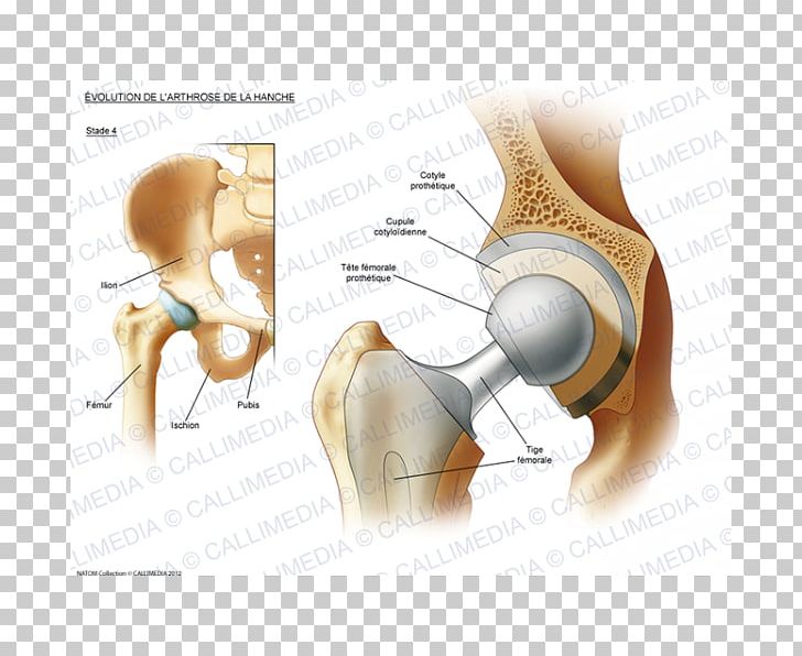 Hip Osteoarthritis Prosthesis Rheumatoid Arthritis PNG, Clipart,  Free PNG Download
