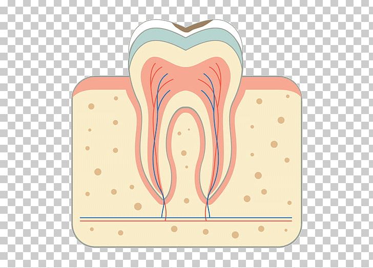 Tooth Decay Periodontal Disease Bridge Root Canal PNG, Clipart, Beneath, Blood Vessels, Bridge, Dental Implant, Dentistry Free PNG Download