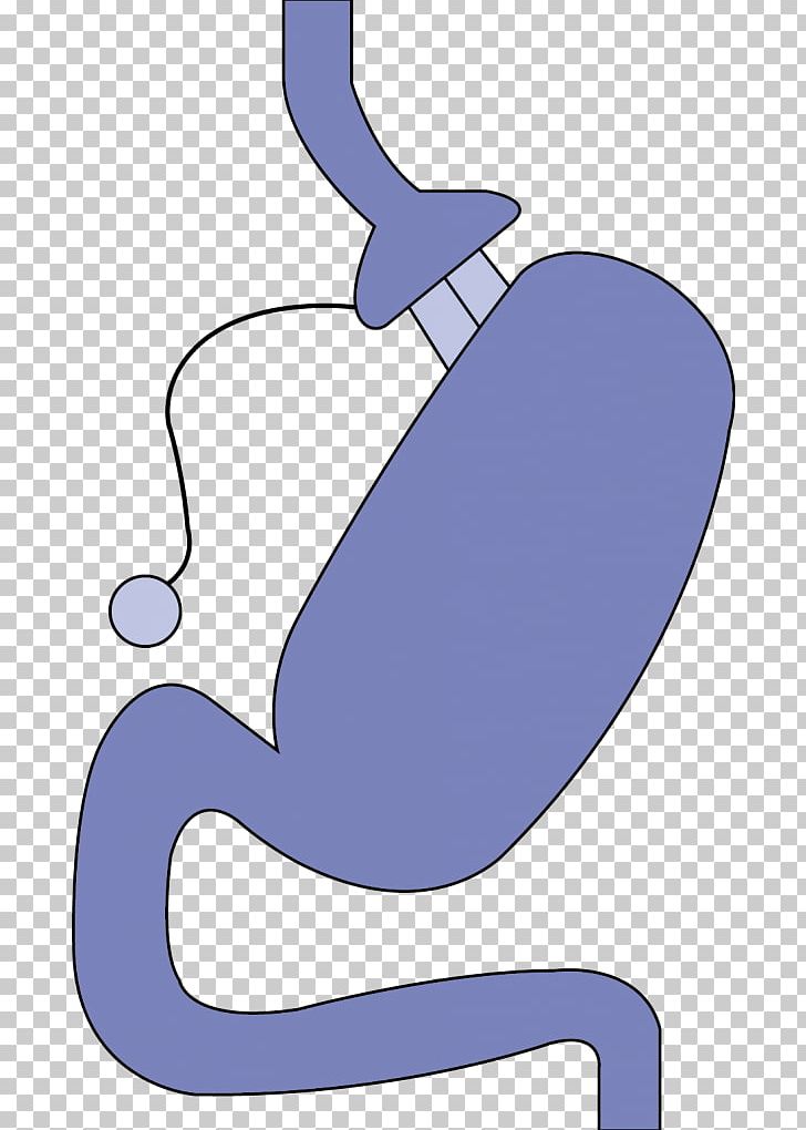 Adjustable Gastric Band Bariatric Surgery Gastric Bypass Surgery Laparoscopy PNG, Clipart, Artwork, Band, Banding, Bariatrics, Bariatric Surgery Free PNG Download